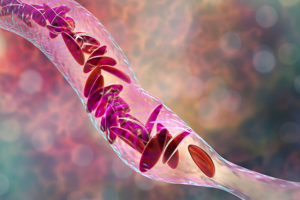 3D illustration of clumps of sickle blood cells flowing through a blood vessel